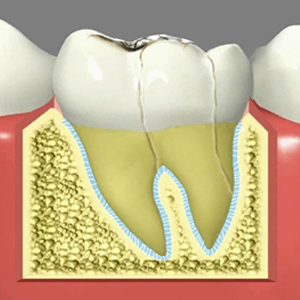 Fractured Teeth