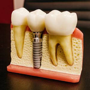 5 Reasons To Get Dental Implants: New Year's Smile | Yorba Linda