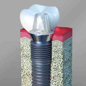 Dental implant restoration procedure and how long does it take