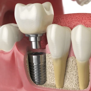 Dental Implants in Yorba Linda: Options for Teens and Adults