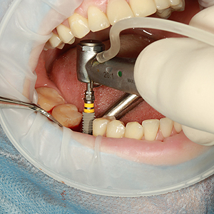 How Long Does It Take for Dental Implants? | Yorba Linda
