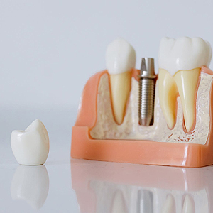 Missing Teeth? Dental Implants Can Help! | Yorba Linda