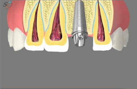 steps for dental implant preparation and surgical placement