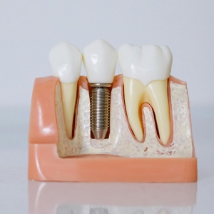 Understanding the Process of Dental Implants in Yorba Linda