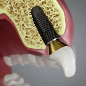 What is Dental Implant Restoration? | Yorba Linda, CA