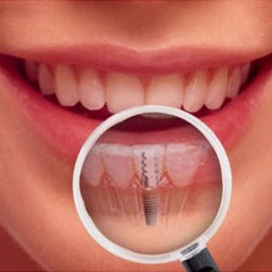 What to Expect After Affixing Dental Implants? | Yorba Linda