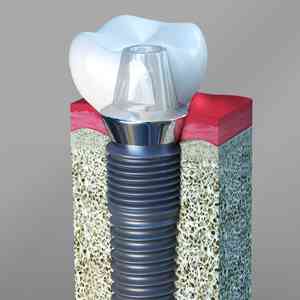 Dental Implant Services in Yorba Linda California