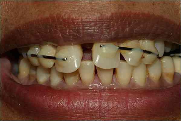 Dental Implants Before