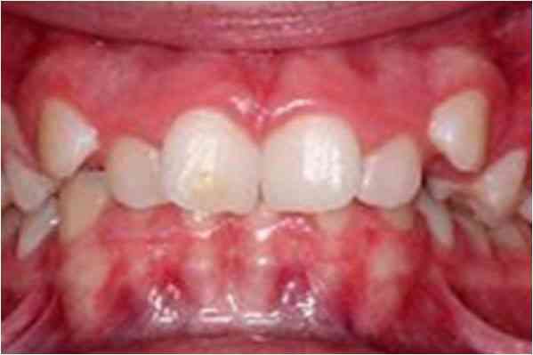 Orthodontics Before