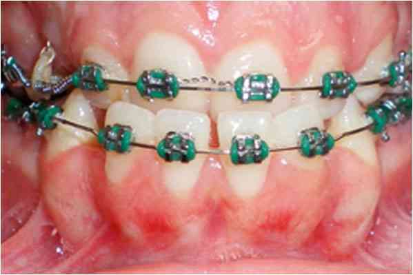 Orthodontics Before