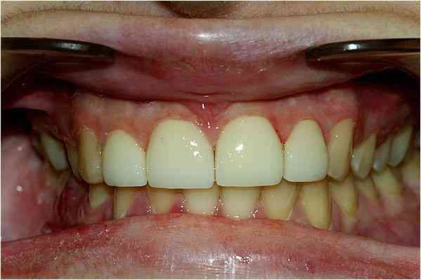 Veneers After 